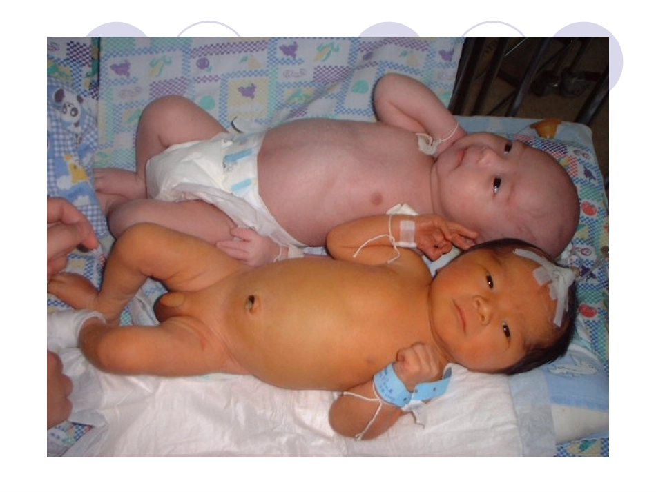 新生儿黄疸的表现及护理_第3页