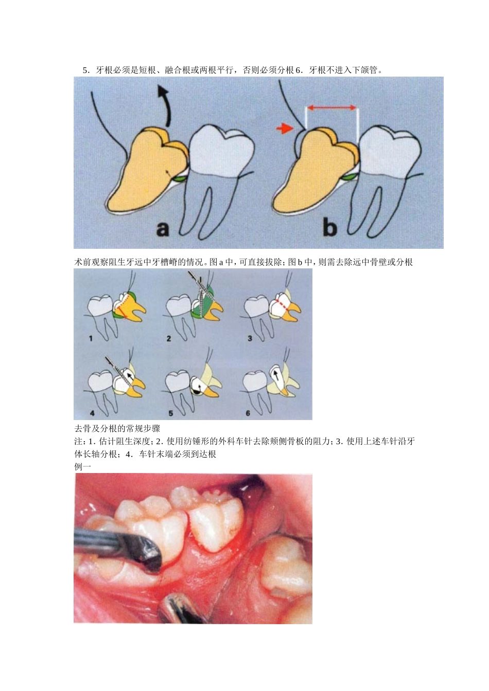 阻生第三磨牙拔除_第3页