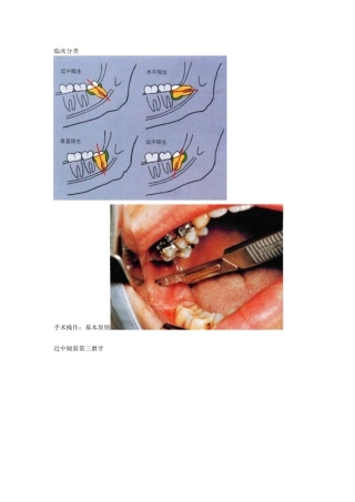 阻生第三磨牙拔除