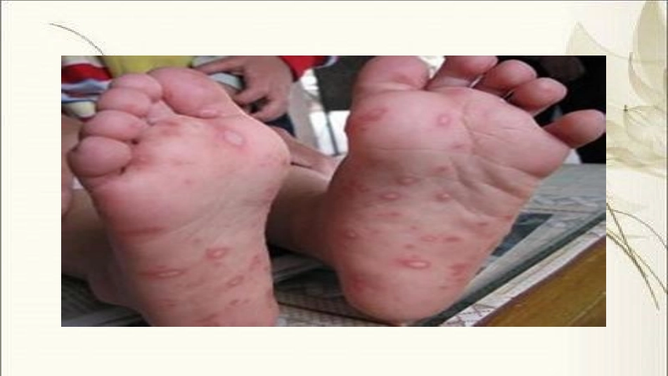 手足口病护理查房_第3页