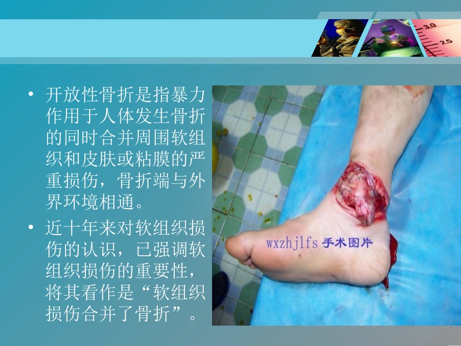 开放性骨折处理_第2页