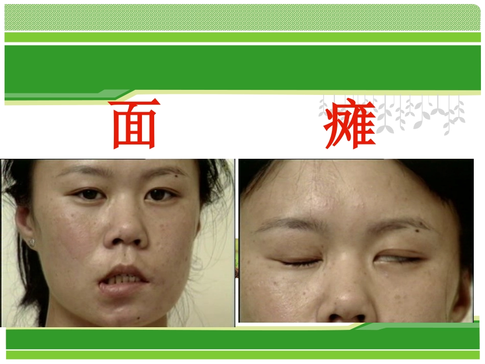 中医面瘫课件_第1页