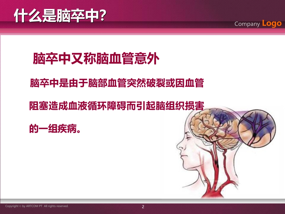 如何预防脑卒中_第2页
