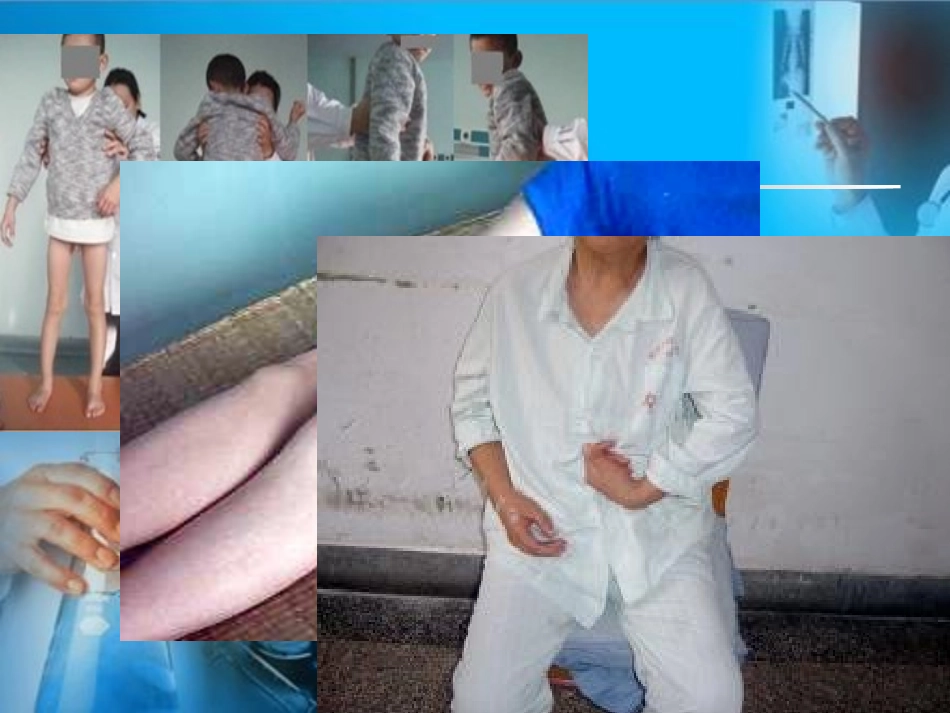 肌张力的评定_第2页