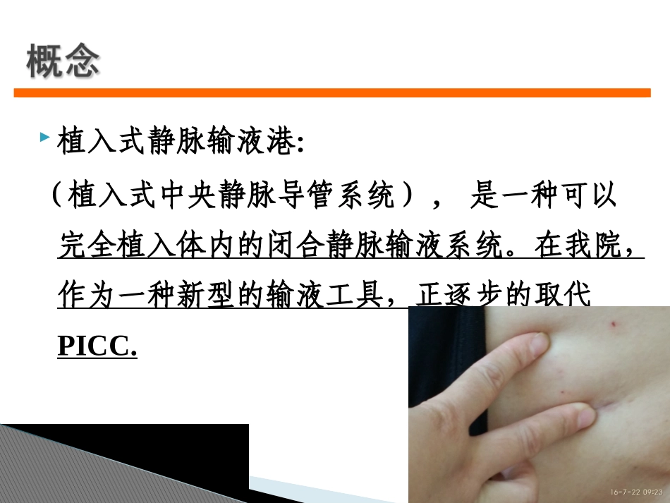 输液港使用常见问题及处理_第2页