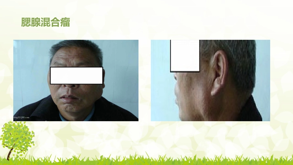 腮腺混合瘤围手术期护理_第3页