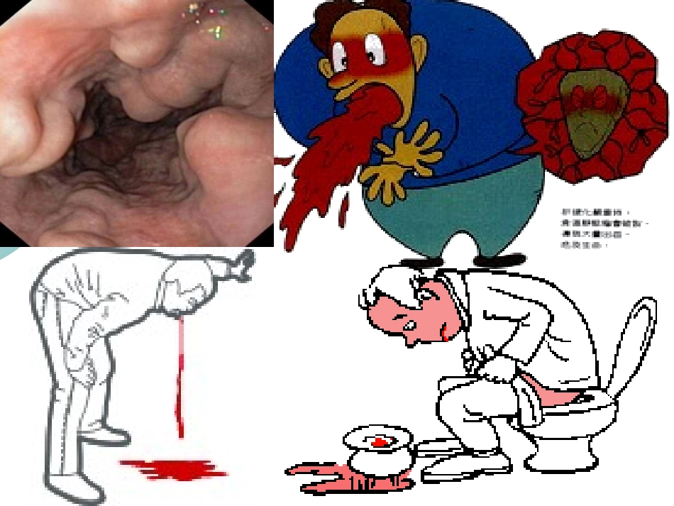 食管胃底静脉曲张破裂出血的治疗 王素平_第2页