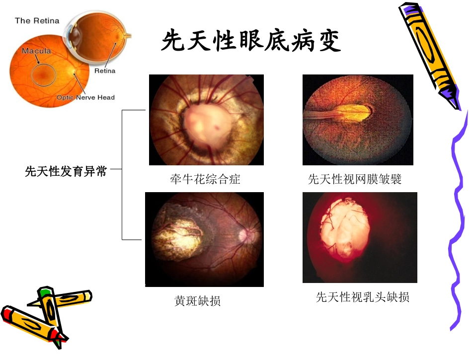 近视眼的防控_第3页