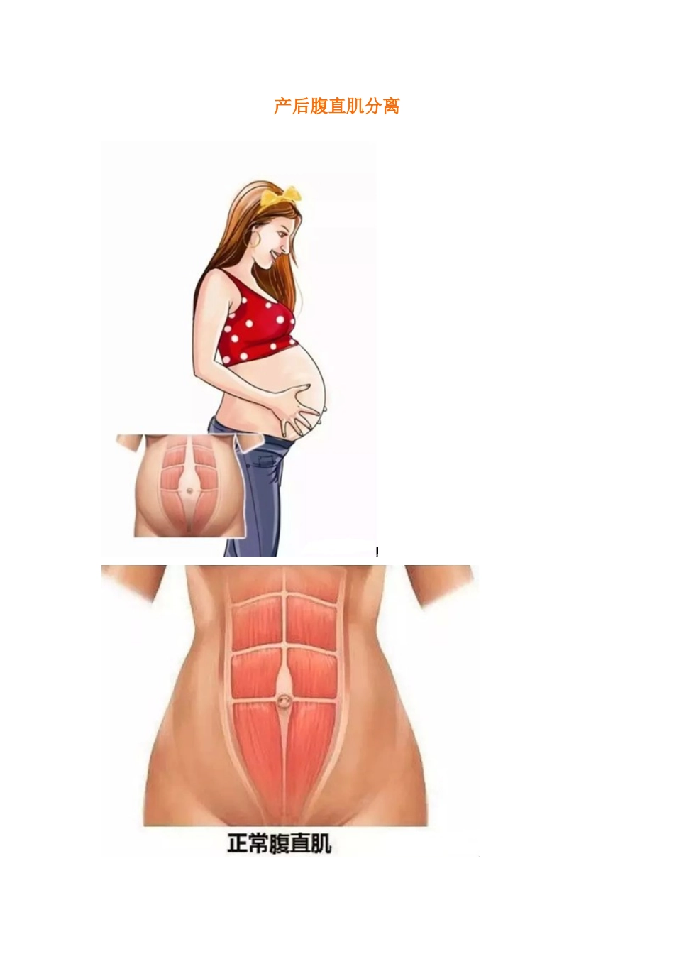 腹直肌分离的预防和治疗_第1页