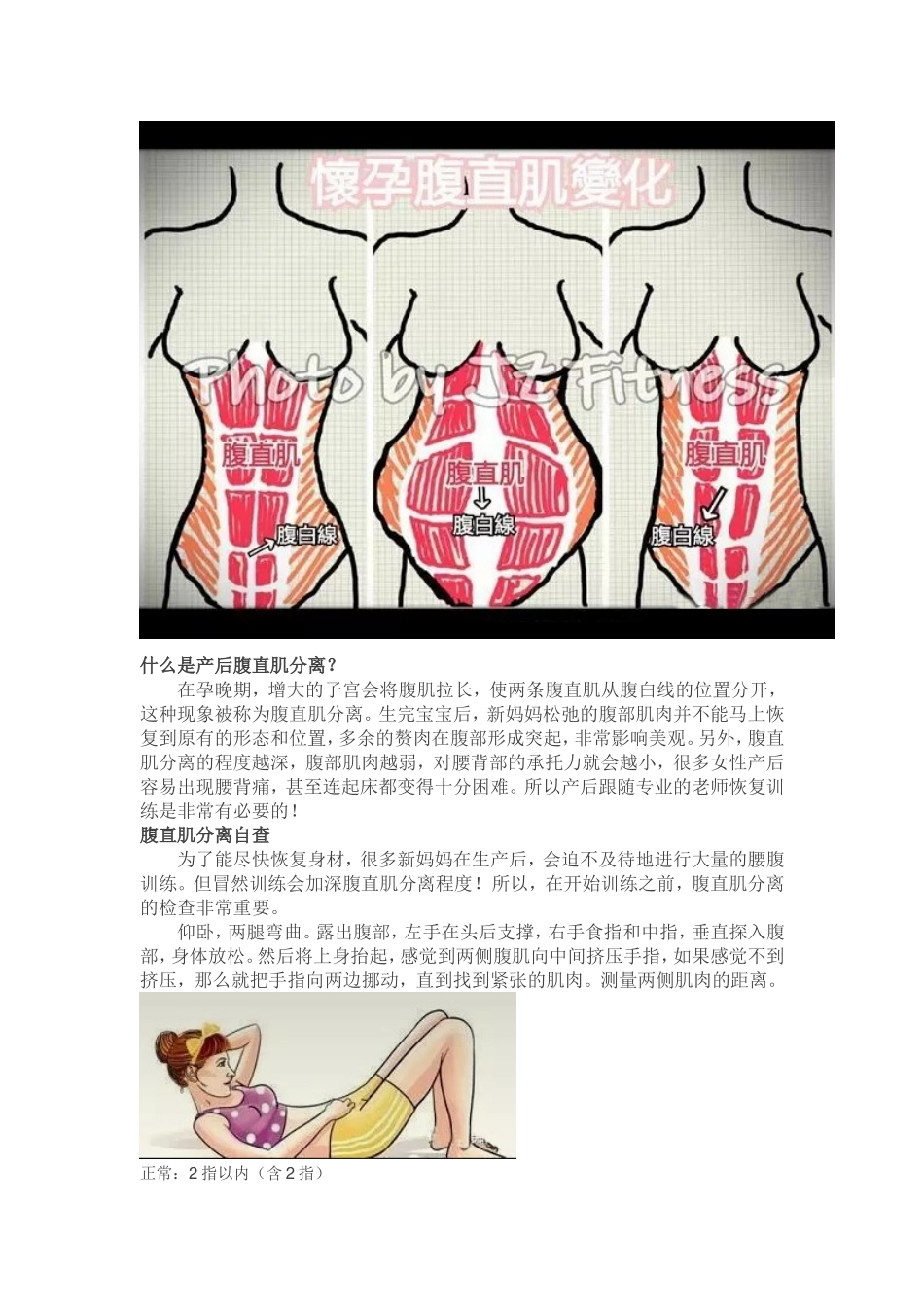 腹直肌分离的预防和治疗_第2页