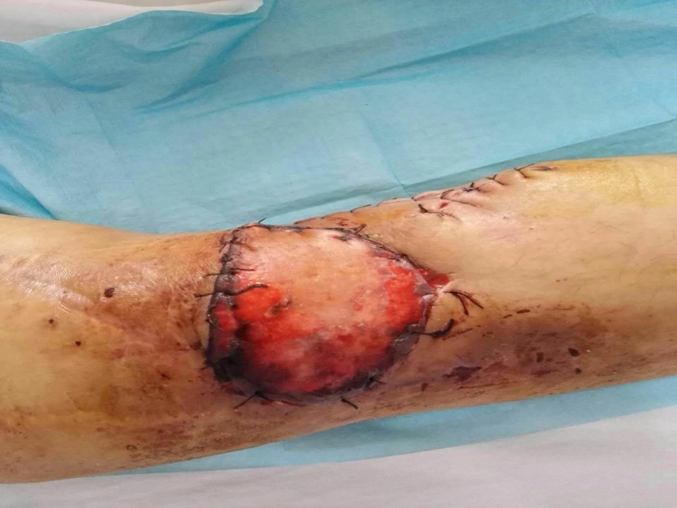 皮瓣移植术及护理ppt课件_第3页