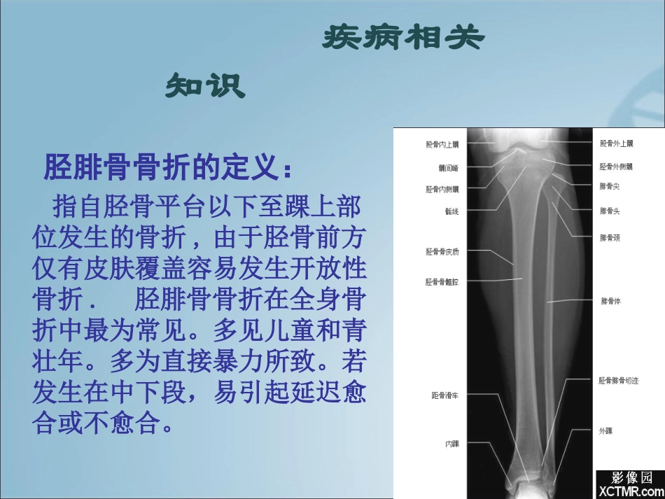 胫腓骨骨折的护理查房_第3页
