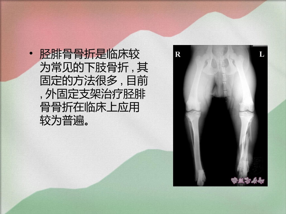 胫骨外固定支架_第2页