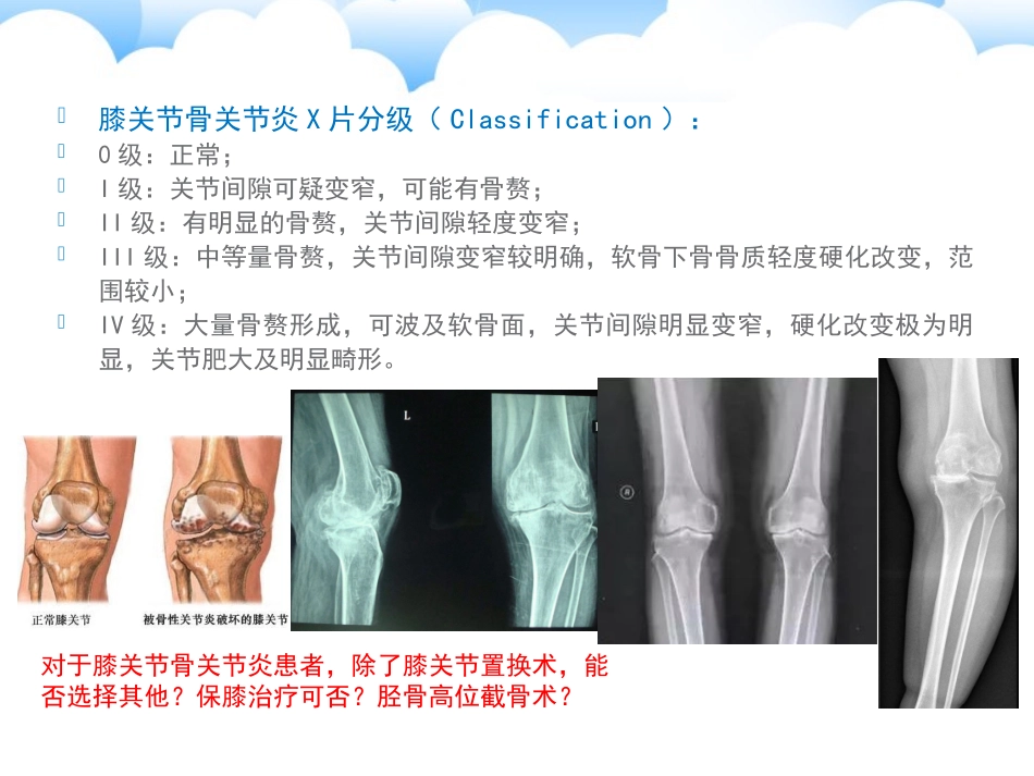 胫骨高位截骨术_第2页