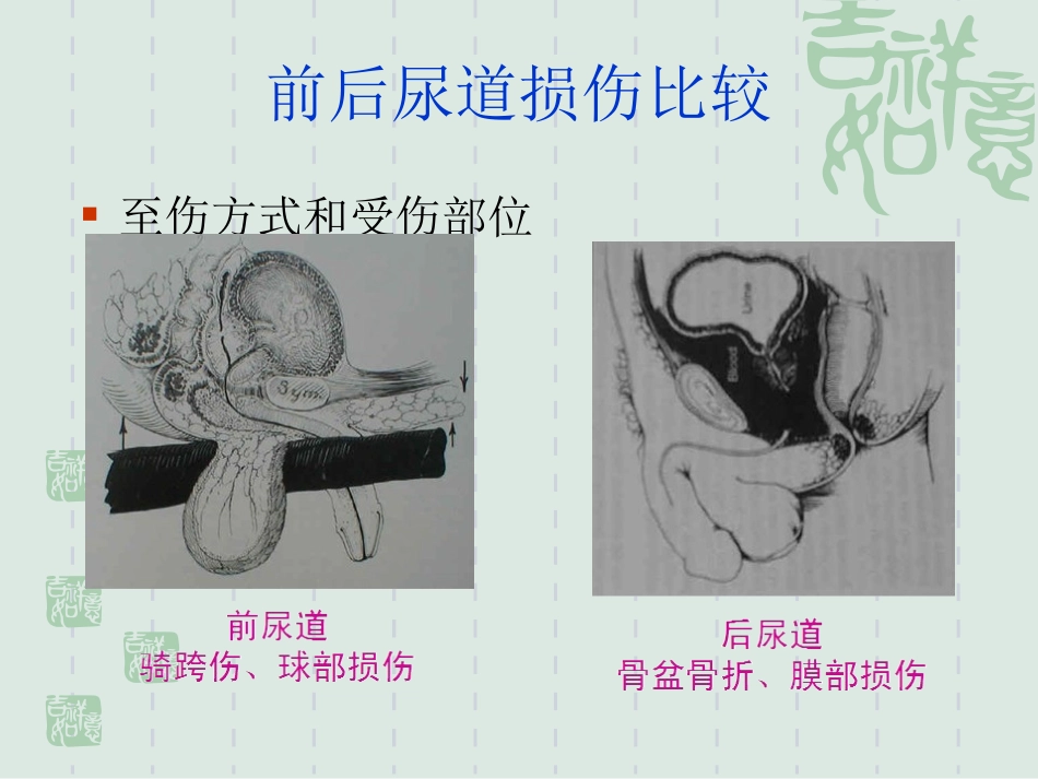 尿道损伤的治疗与护理_第3页