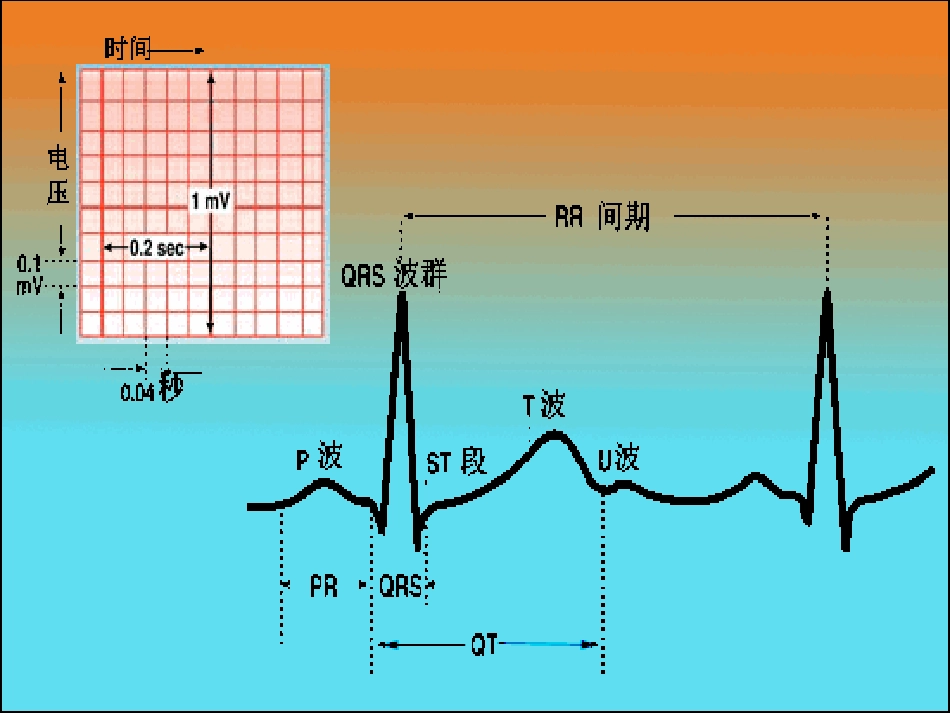 正常心电图及常见异常心电图的识别及处理_第3页