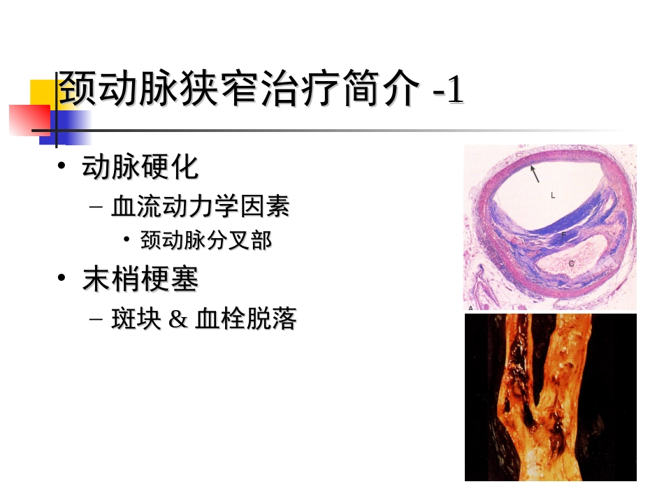 颈动脉及颅内支架_第2页