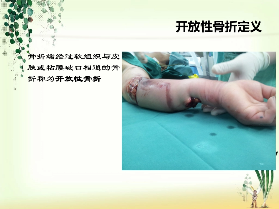 开放性骨折的处理_第2页