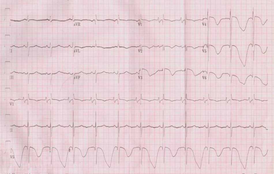 获得性长QT尖端扭转性室速;朱俊_第3页