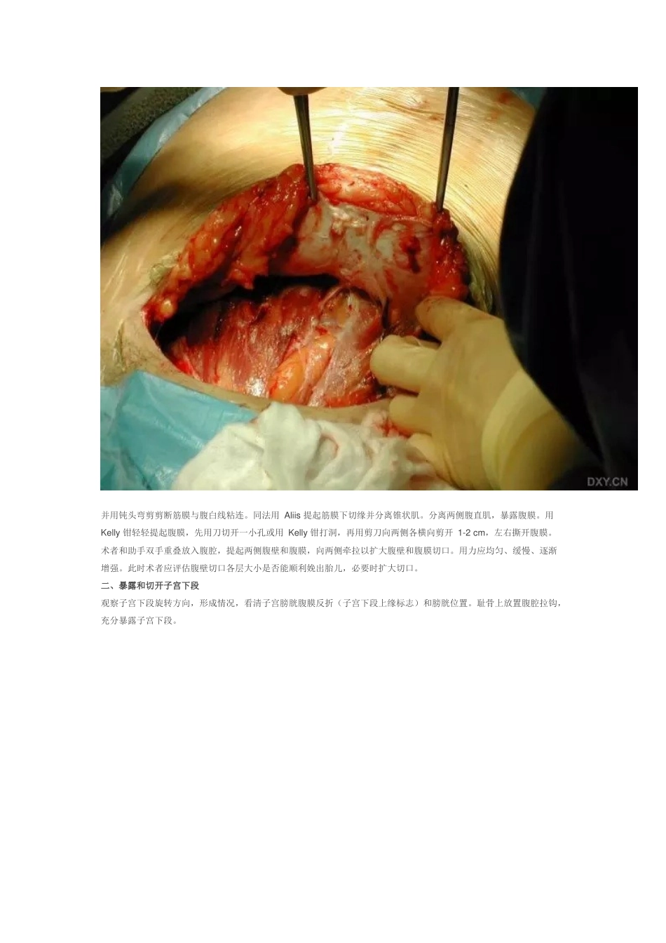 剖宫产手术流程(含图)_第2页