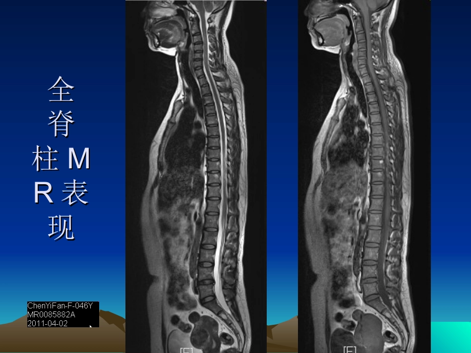 脊柱外伤影像学表现_第3页