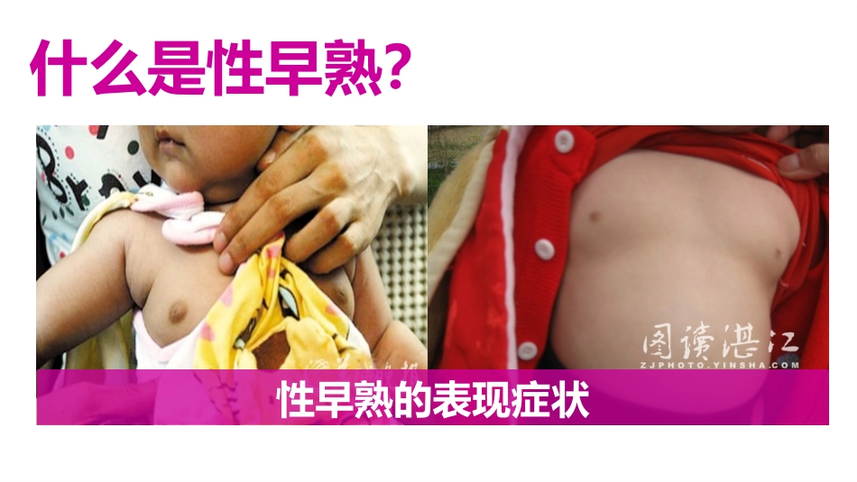 中医药防治性早熟_第2页