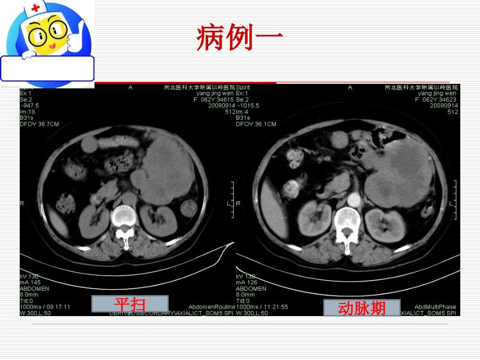 胃肠道间质瘤的影像诊断_第3页