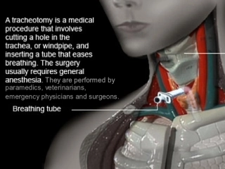 气管切开术(Tracheotomy)