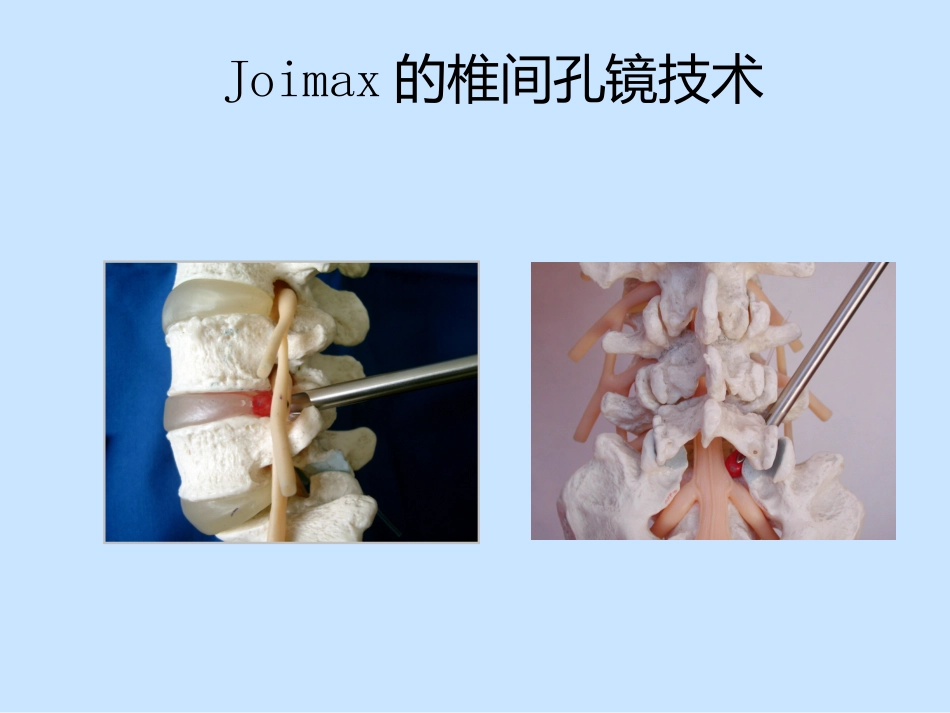 椎间孔镜手术操作方法_第1页