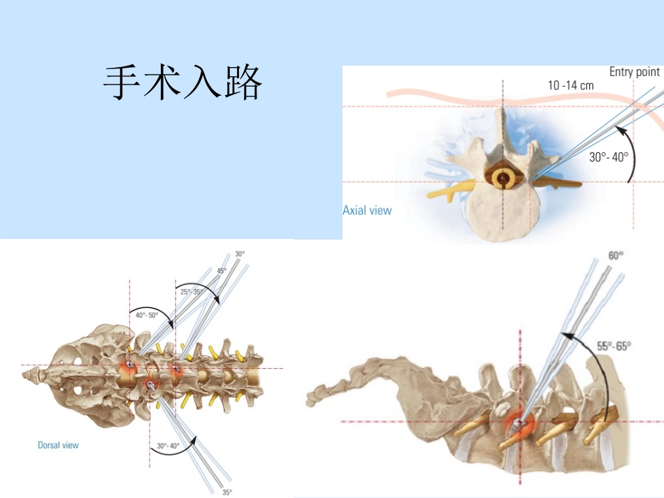椎间孔镜手术操作方法_第3页