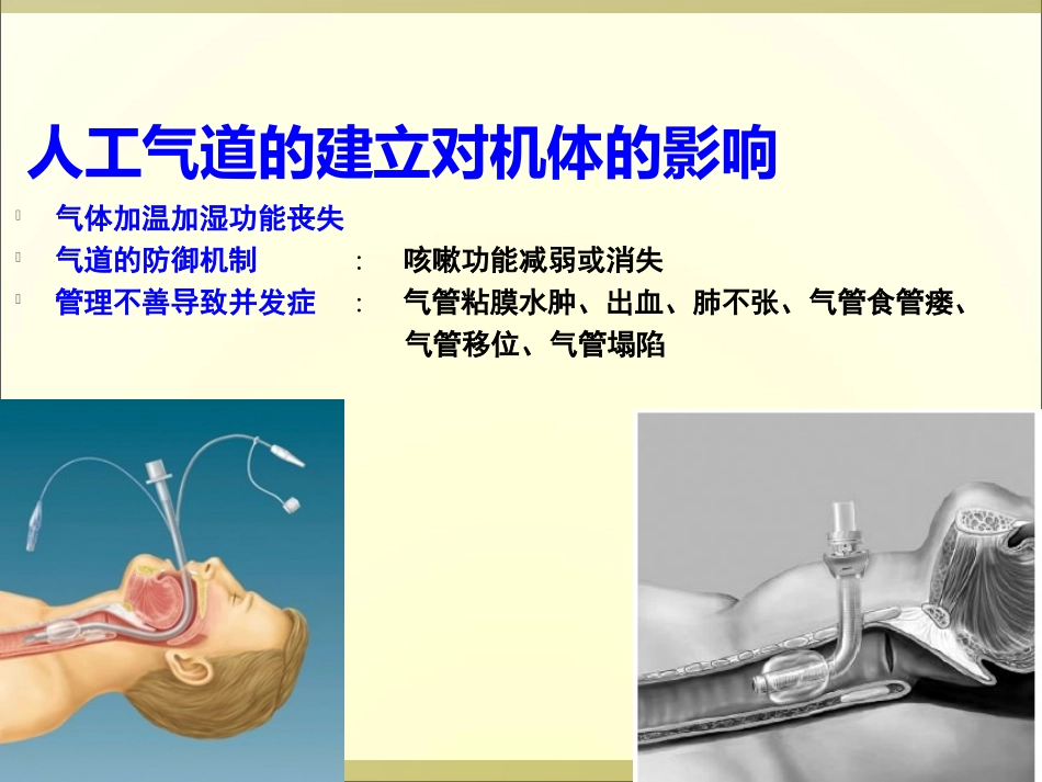 人工气道的管理_第3页