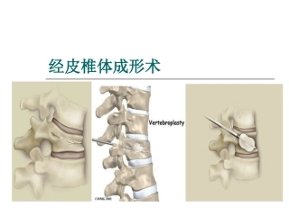 经皮椎体成形术