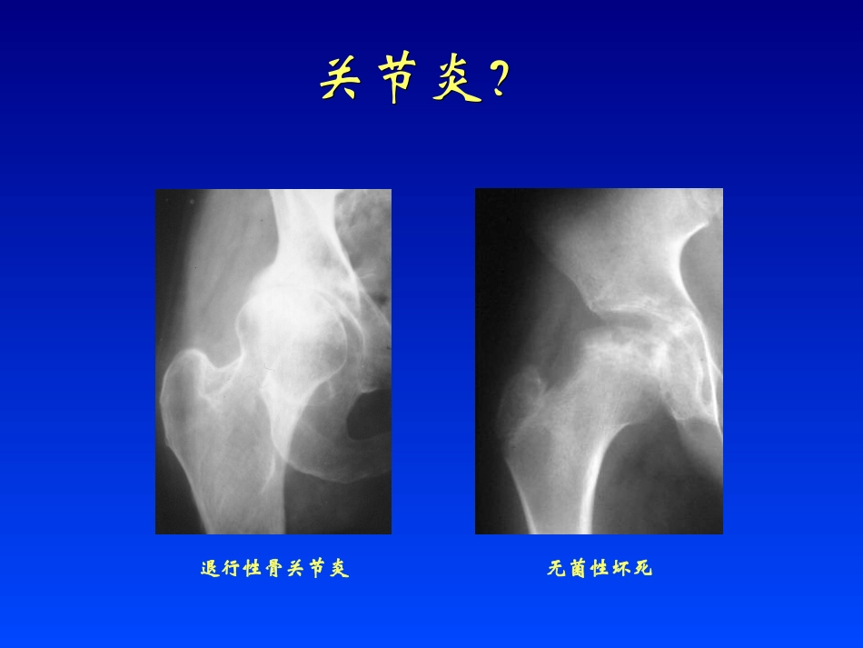 关节炎的影像学表现_第3页
