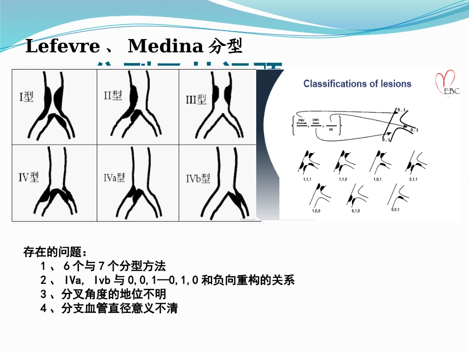 分叉病变的分型和术式选择_第2页