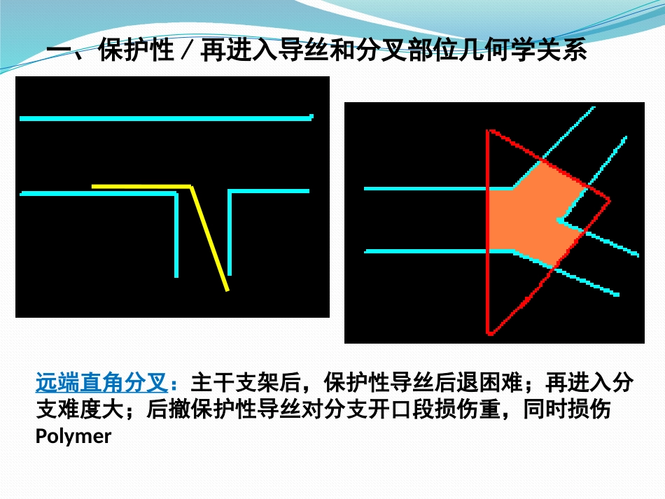 分叉病变的分型和术式选择_第3页