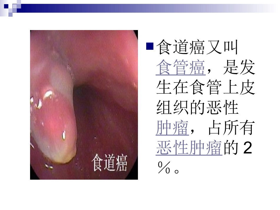 食道癌ppt_第2页