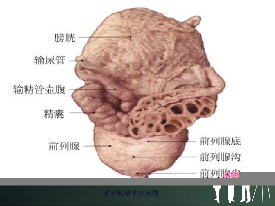 经尿道前列腺电切术的健康教育_第3页
