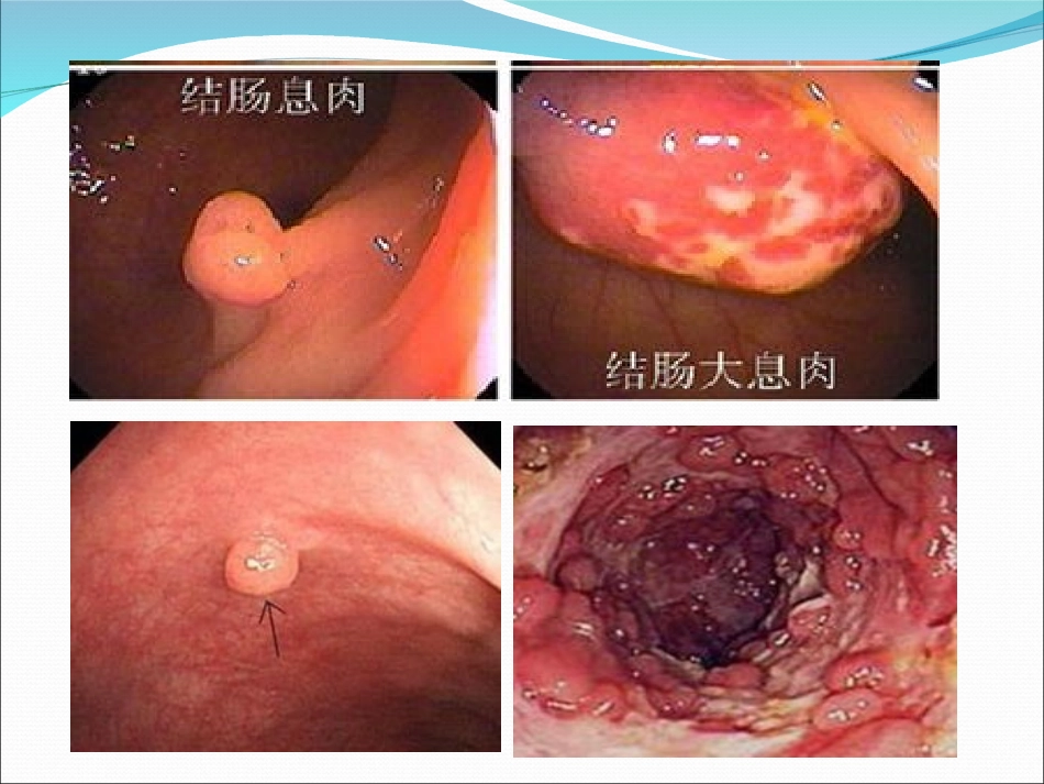 教学查房结肠息肉_第2页
