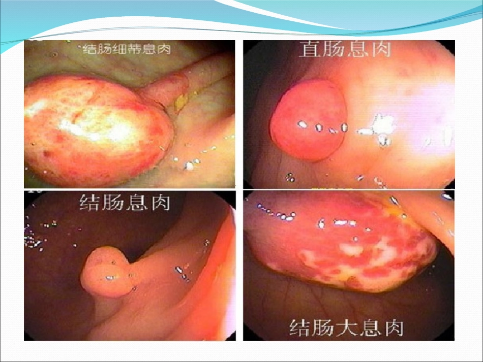 教学查房结肠息肉_第3页