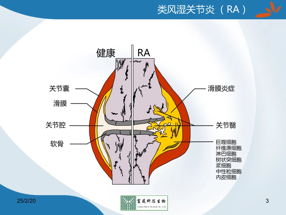 类风湿关节炎的新筛查指标——抗CCP抗体(GICA法)_第3页
