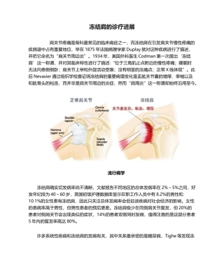 2025年冻结肩的诊疗进展