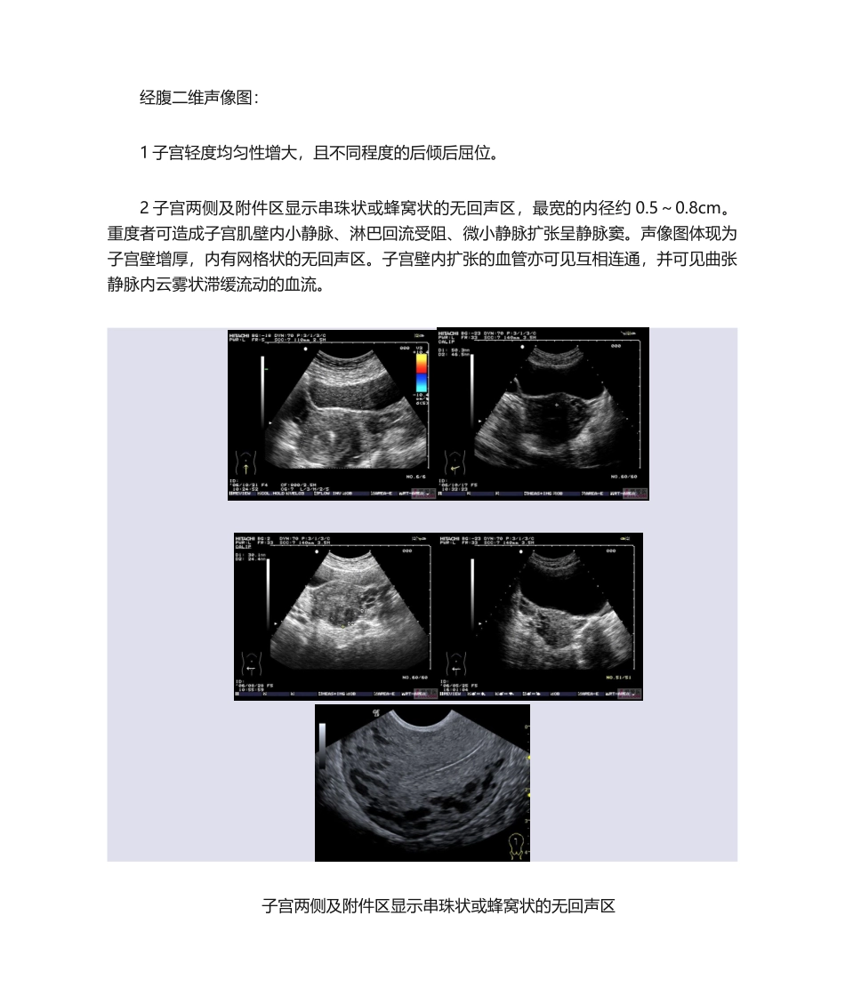 2025年盆腔静脉曲张症_第3页