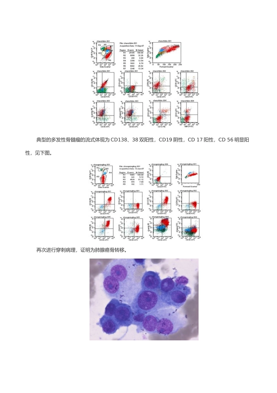 2025年多发性骨髓瘤的鉴别诊断_第3页