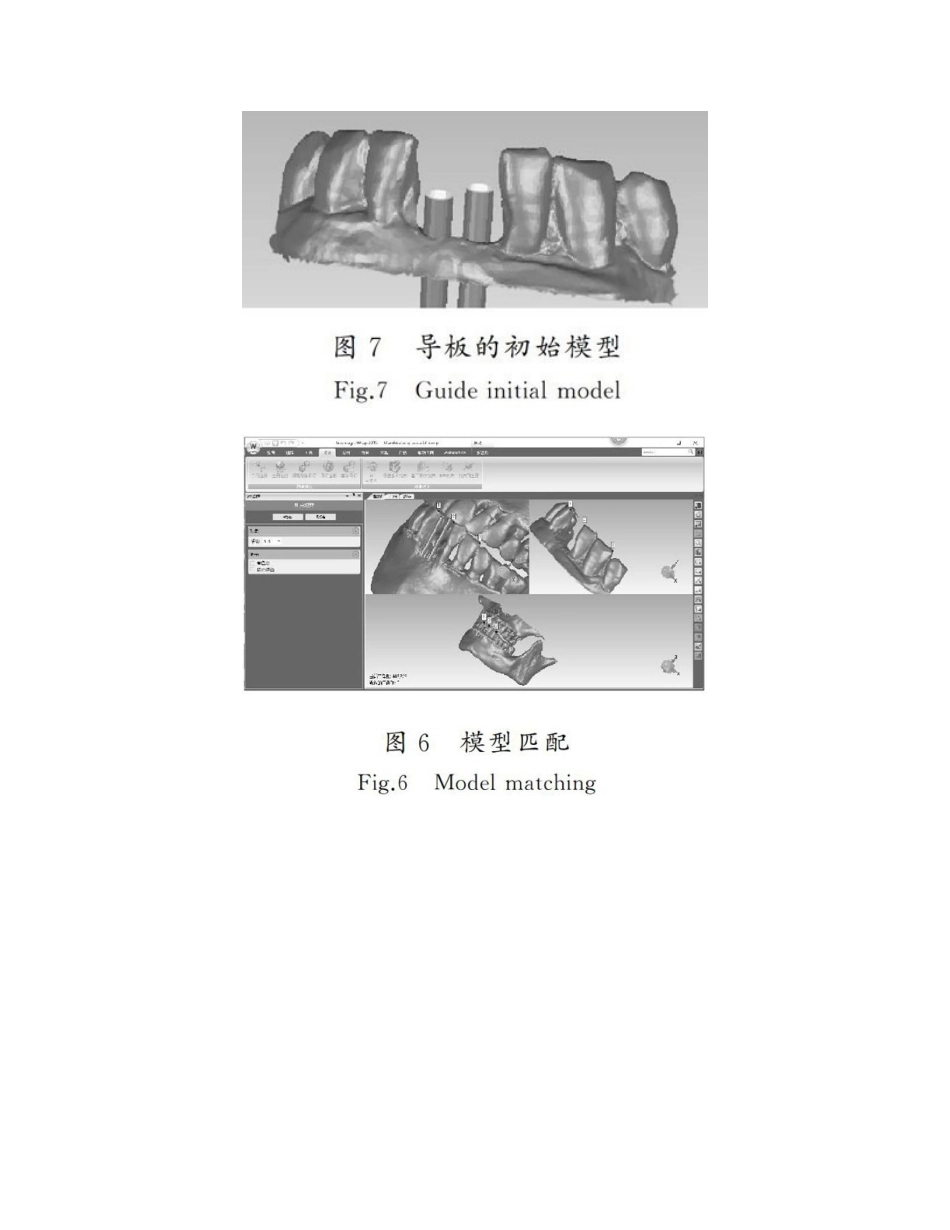 2025年口腔种植导板的数字化设计和三D打印_第2页
