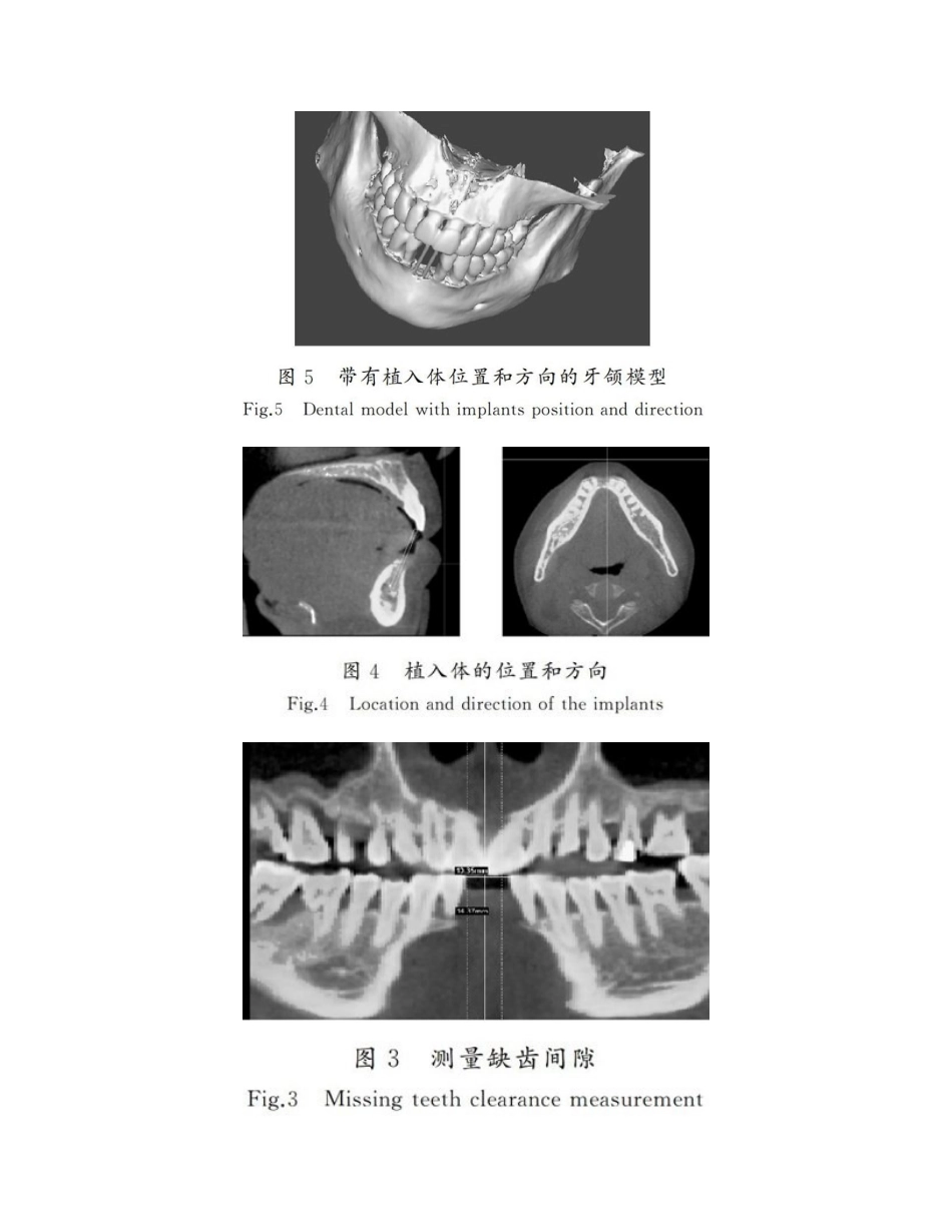 2025年口腔种植导板的数字化设计和三D打印_第3页