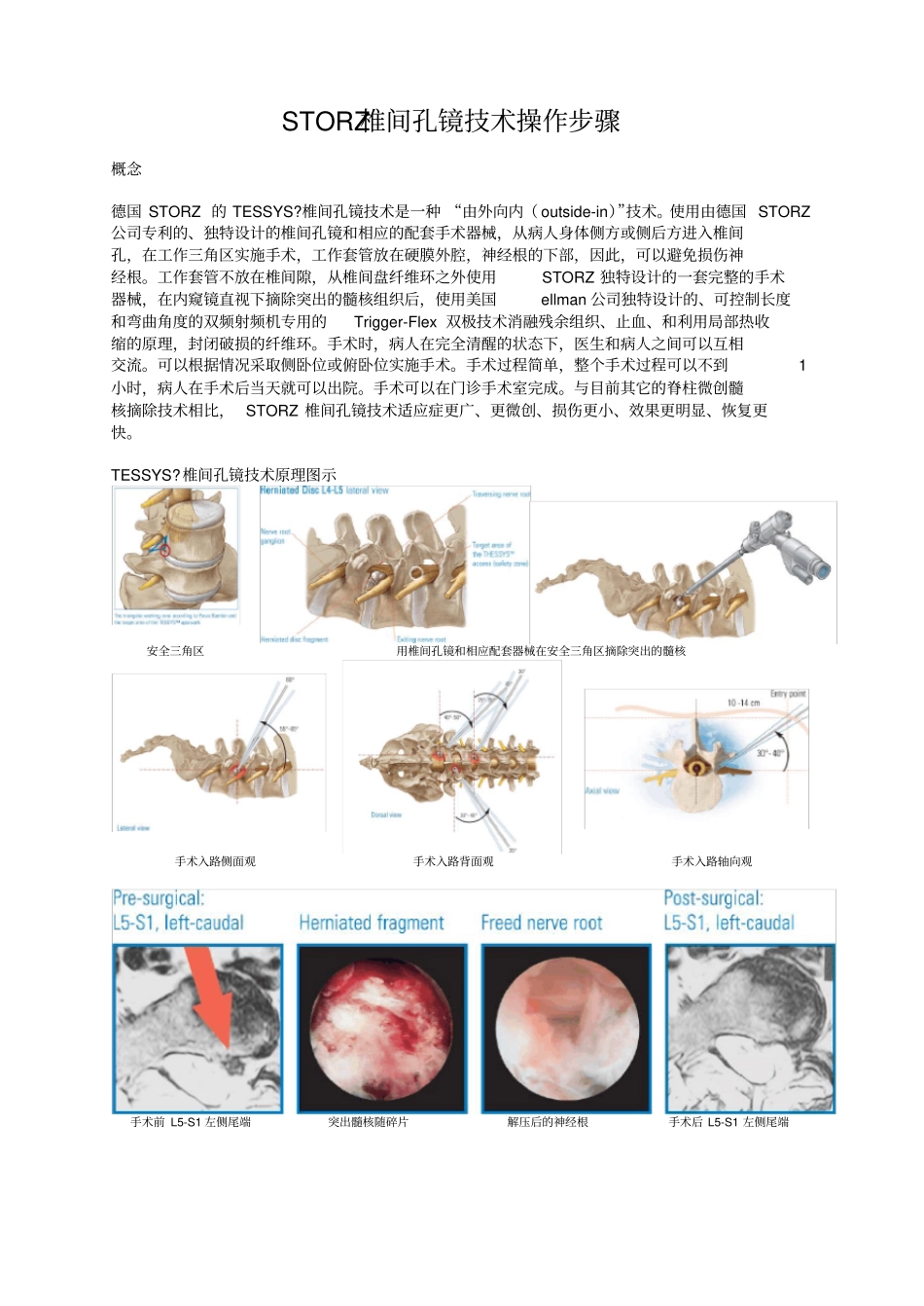 全部步骤椎间孔镜手术_第1页