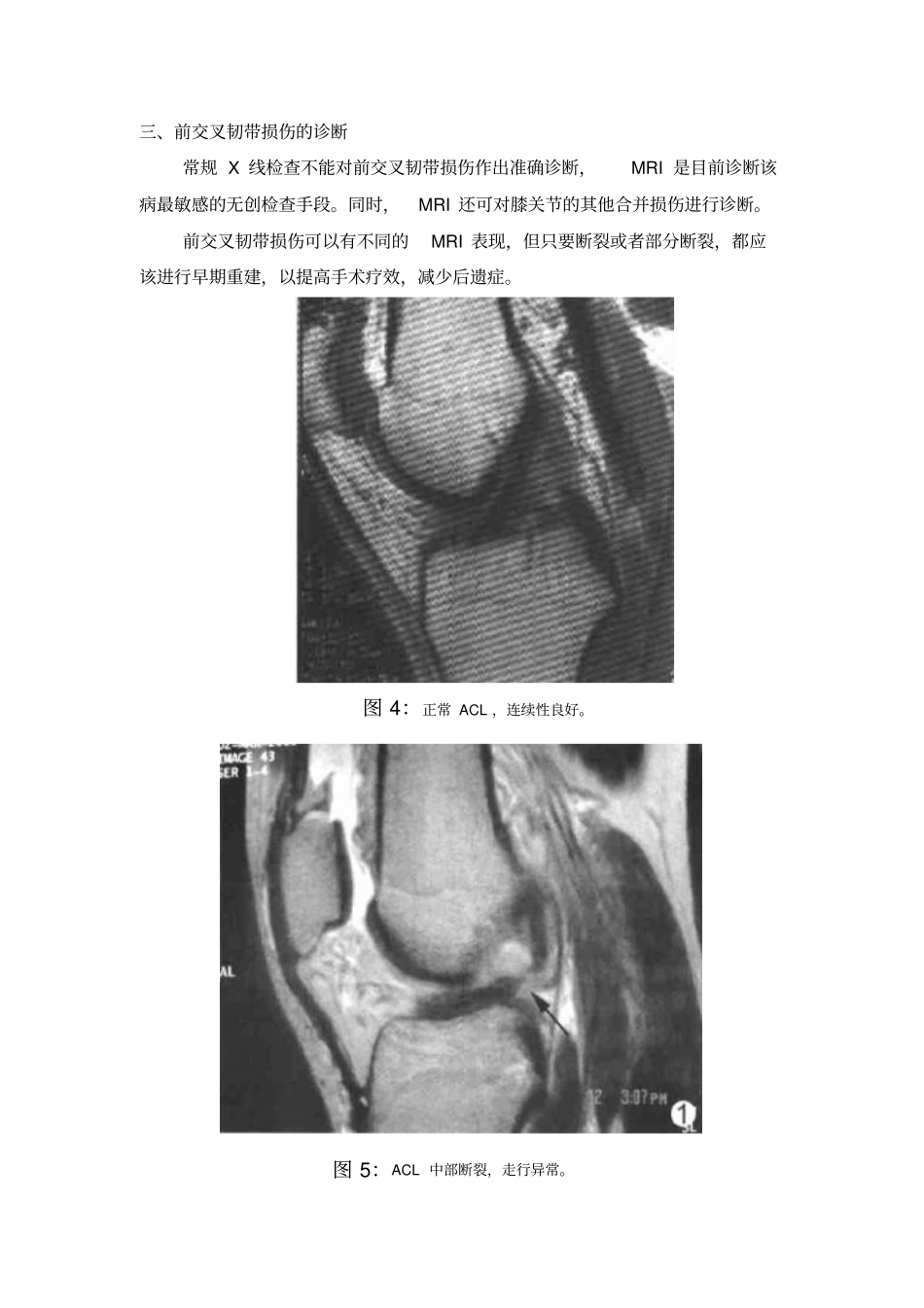 前交叉韧带损伤患者须知概论_第3页