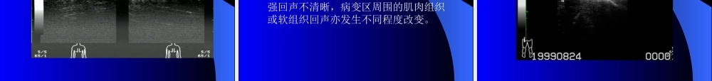 周围神经损伤的超声诊断