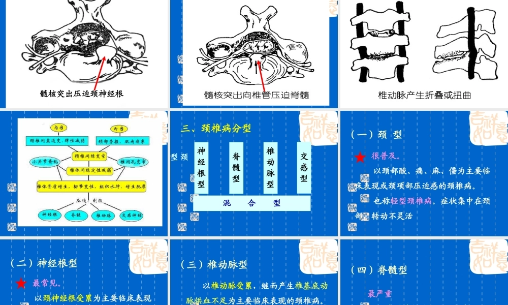 颈椎病---ppt课件