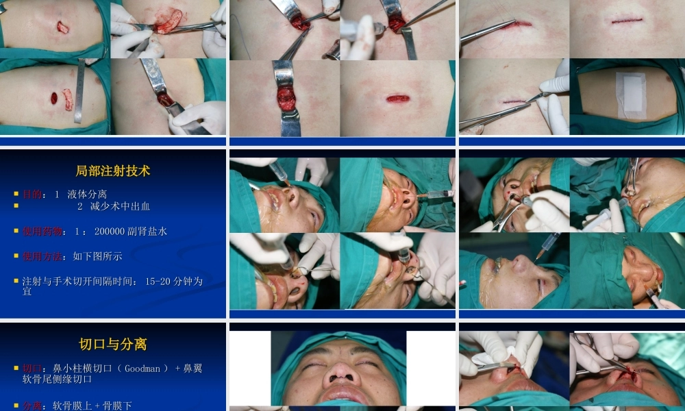 肋软骨鼻整形技术.ppt